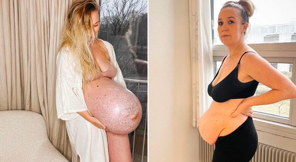 Mom of triplets shows her pre and post-?????
